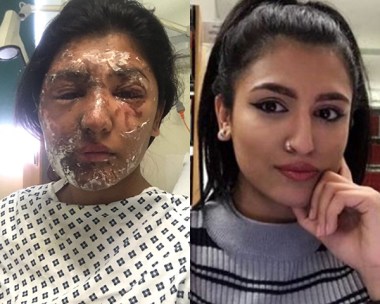 Model attacked with acid on her 21st birthday shows her amazing recovery one year on